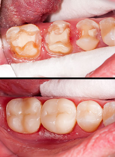 Howard I. Deutsch, DDS | Veneers, Root Canals and Preventative Program