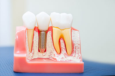 Howard I. Deutsch, DDS | Crowns, Pediatric Dentistry and Preventative Program
