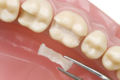 Howard I. Deutsch, DDS | Root Canals, Night Guards and Dentures