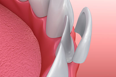 Howard I. Deutsch, DDS | Sports Mouthguards, Pediatric Dentistry and Preventative Program