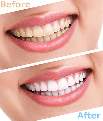 Howard I. Deutsch, DDS | Teeth Whitening, Dentures and Night Guards