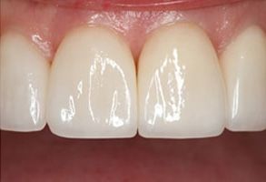 Howard I. Deutsch, DDS | Extractions, Dental Bridges and Teeth Whitening