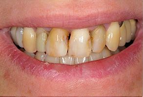 Howard I. Deutsch, DDS | Night Guards, Implant Dentistry and Preventative Program